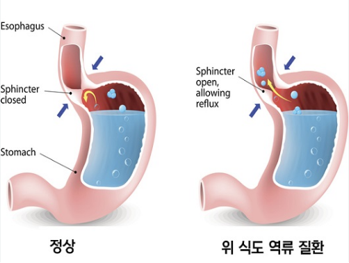 역류성 식도염