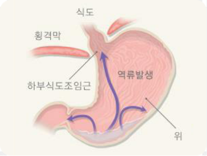 역류성 식도염