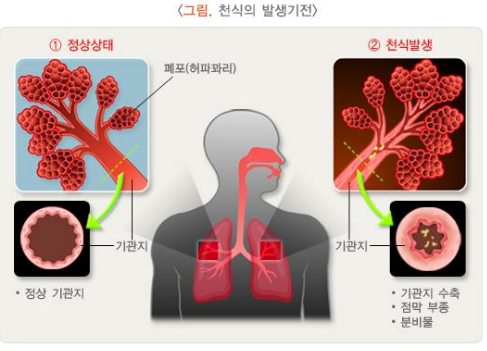 천식 흡입기