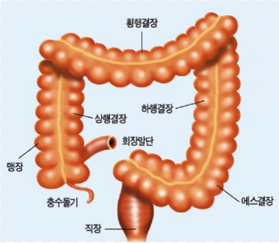 대장암