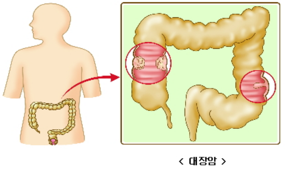 대장암