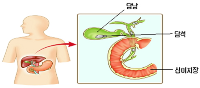 담석증